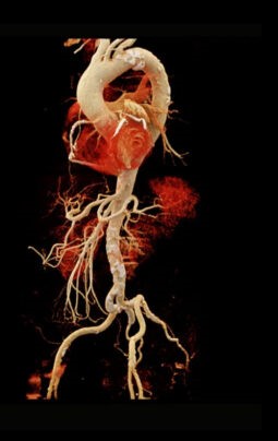 CT Angiography